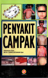 Penyakit Campak